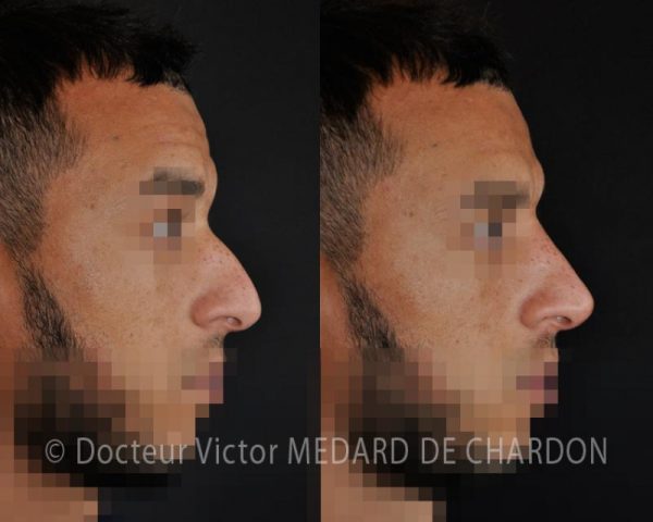 Rhinoplastie médicale Cannes Dr Médard de Chardon