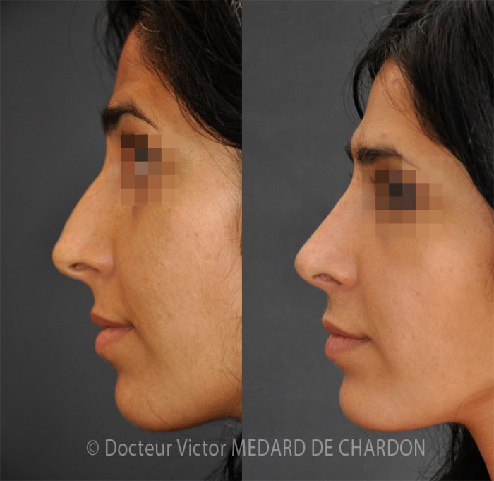 Rhinoplastie Ultrasonique Cannes Dr Médard De Chardon