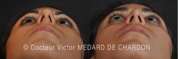 Rhinoplastie Ultrasonique Cannes Dr Médard De Chardon