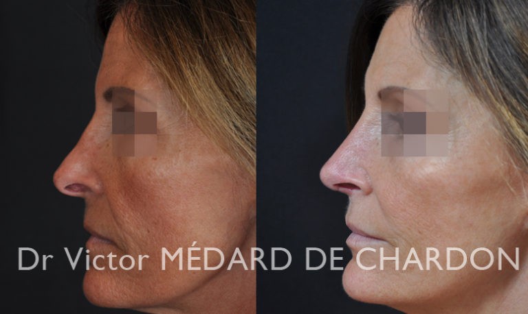 Photos Avant Après De Rhinoplastie Dr Medard De Chardon